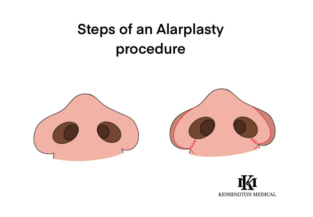 Steps of an Alarplasty Procedure