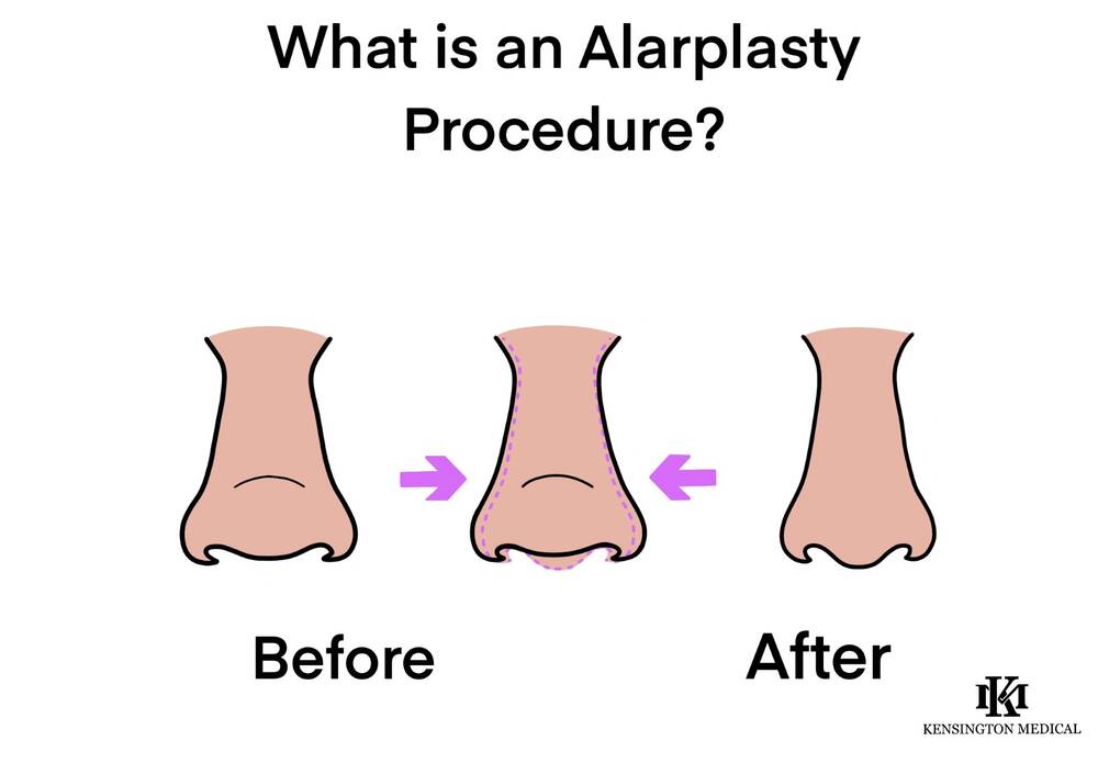 Alarplasty Before and After