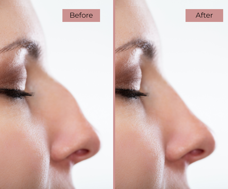 Before and After Rhinoplasty Surgery