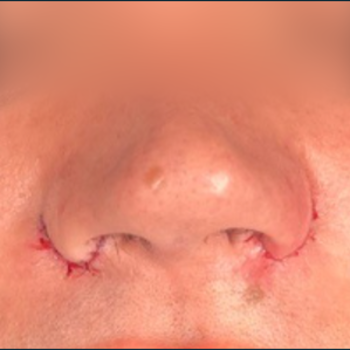 Alar Base Reduction / nostril reshaping before and after photos