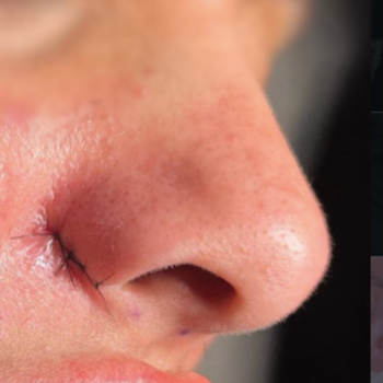 Alar Base Reduction / nostril reshaping before and after photos
