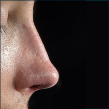 Rhinoplasty, before and after photographs