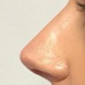 Rhinoplasty and dorsal hump, before and after photographs