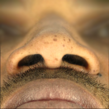 Alar Base Reduction / nostril reshaping before and after photos