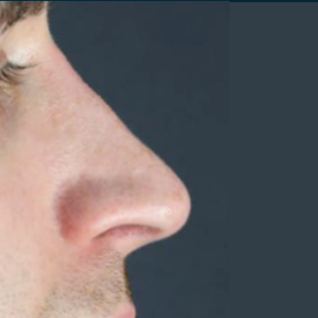 Rhinoplasty, before and after photographs