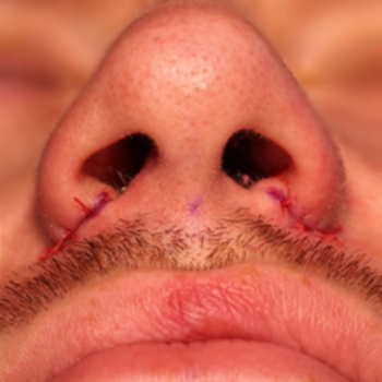 Alar Base Reduction / nostril reshaping before and after photos